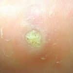 Dornwarzen in Nahaufnahme