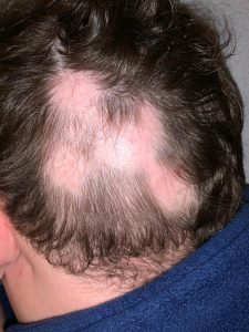 Alopecia areata 2 kahle Stellen