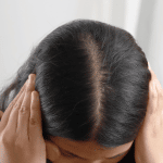 Erblich bedingter Haarausfall bei Frau