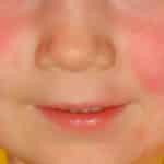 Scharlach Wangen bei Kind