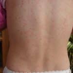 Scharlach-Ausschlag am Rücken