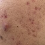 akne beim mann im gesicht