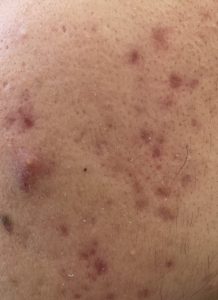 akne beim mann im gesicht