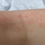 Neurodermitis in der Ellenbeuge