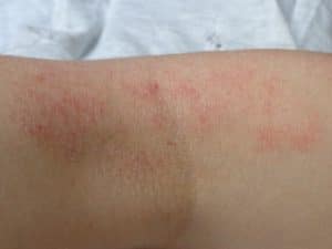 Neurodermitis in der Ellenbeuge