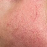 Rosazea im Frühstadium I (Couperose)