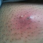 Eiterbeutel an der Haarwurzel