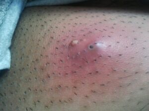 Eiterbeutel an der Haarwurzel