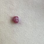 Blutschwamm, Wucherung der kleinen Blutgefäße