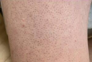 Keratosis pilaris Bein