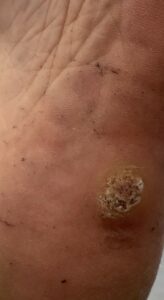 Warze an der Fußunterseite