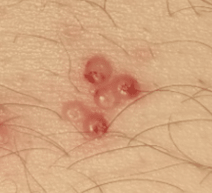 dellwarze auf der haut