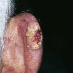 Plattenepithelkarzinom an der rechten Ohrhelix