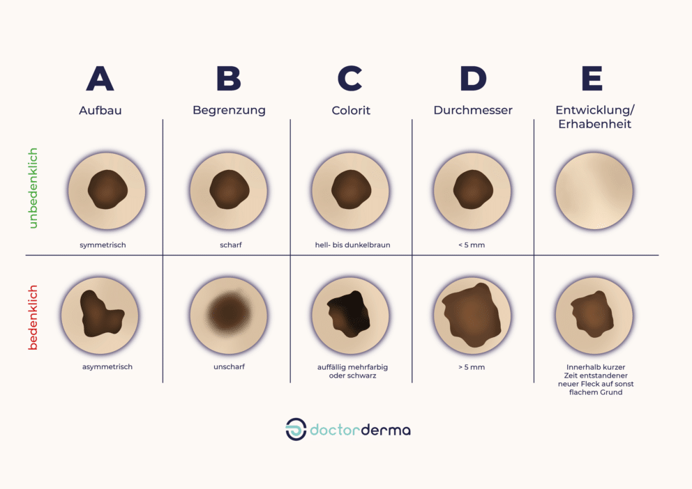 Die ABCDE-Regel dient zu Ersteinschätzung von Leberflecken. ABCDE Regel mit Beispielen