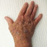 Aktinische Keratose am rechten Handrücken