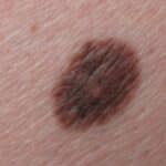 Unauffälliges Muttermal an der linken Gesäßhälfte