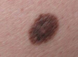 Unauffälliges Muttermal an der linken Gesäßhälfte