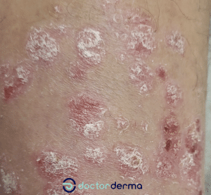 Psoriasis