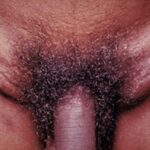 Lymphogranuloma venereum