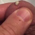 Ausfluss Tripper beim Mann