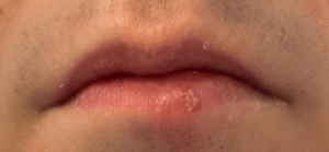 Lippenherpes 2