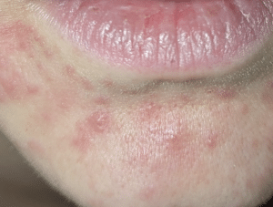 Periorale Dermatitis