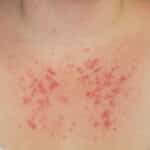 Blasenbildung als Symptom von Sonnenallergie am Dekolleté