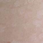 Kleienpilzflechte Läsionen