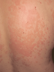 Kleienpilzflechte Rücken