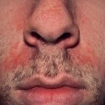 Seborrhoisches Ekzem Gesicht