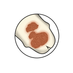 Feigwarze (Condylomata accuminata)