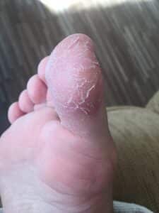 Fußpilz schuppige Haut