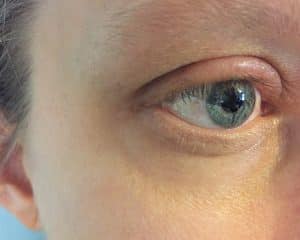 Allergie, geschwollenes Auge