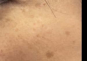 Sonnenflecken im Gesicht