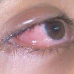 Hausstauballergie, Konjunktivitis