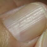 Nagelkrankheit Längsrillen