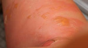 Verbrennung 2. Grades