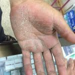 Handpilz and der Handfläche