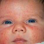 Neugeborenenakne