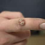 Stachelwarze, Verrucae vulgaris