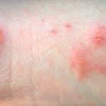 Allergisches Kontaktekzem