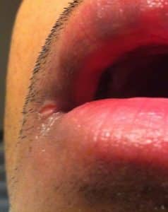 Eingerissene Mundwinkel