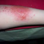 Nässende Kontaktdermatitis am Unterarm mit Blasenbildung.