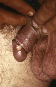 Weicher Schanker, Penis