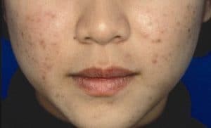 Postinflammatorische Hyperpigmentierung bei Akne