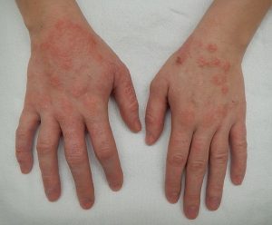 irritative Dermatitis Hand