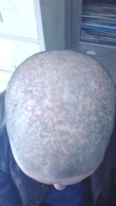 Tinea Capitis des gesamten Kopfes