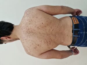 Narben auf gesamten Rücken nach Akne Erkrankung