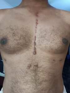 Narbe nach Operation am Sternum