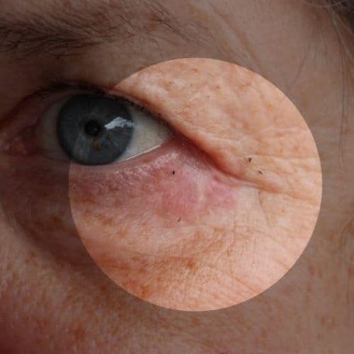 Lidekzem unterhalb des Auges  © Frank C. Müller (CC BY-SA 4.0)